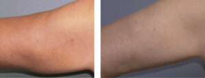 Smartlipo®