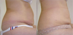 Smartlipo®